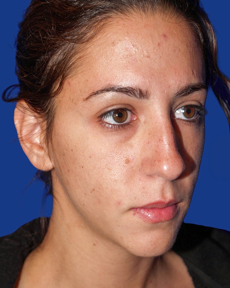 Rhinoplasty Before & After