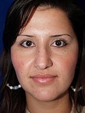 Rhinoplasty Before & After