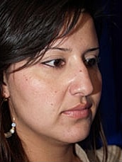 Rhinoplasty Before & After
