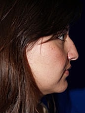 Rhinoplasty Before & After