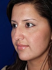 Rhinoplasty Before & After