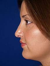 Rhinoplasty Before & After