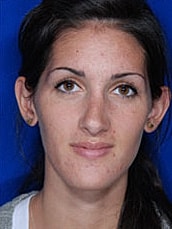 Rhinoplasty Before & After