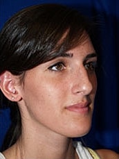 Rhinoplasty Before & After