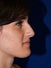 Rhinoplasty Before & After