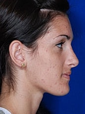 Rhinoplasty Before & After