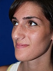 Rhinoplasty Before & After
