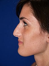 Rhinoplasty Before & After