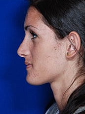 Rhinoplasty Before & After