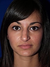 Rhinoplasty Before & After