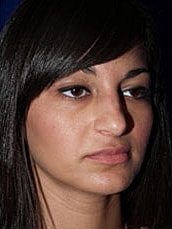 Rhinoplasty Before & After
