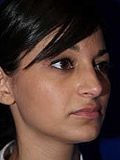 Rhinoplasty Before & After