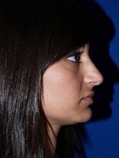 Rhinoplasty Before & After