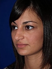 Rhinoplasty Before & After