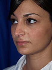 Rhinoplasty Before & After