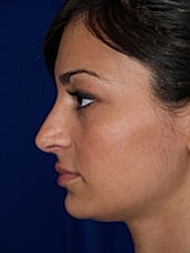 Rhinoplasty Before & After