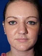 Rhinoplasty Before & After