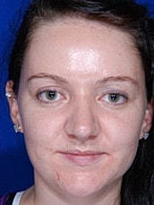 Rhinoplasty Before & After