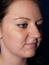 Rhinoplasty Before & After