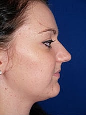 Rhinoplasty Before & After
