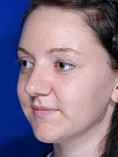 Rhinoplasty Before & After