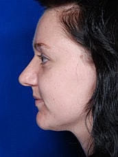 Rhinoplasty Before & After