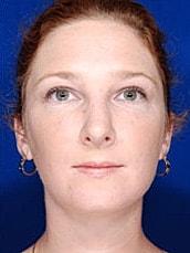 Rhinoplasty Before & After