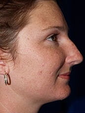 Rhinoplasty Before & After