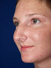 Rhinoplasty Before & After