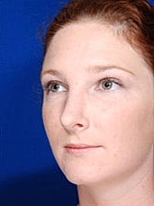 Rhinoplasty Before & After