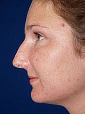 Rhinoplasty Before & After