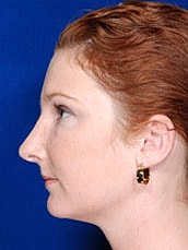 Rhinoplasty Before & After