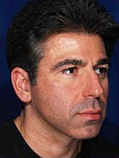 Rhinoplasty Before & After