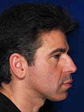 Rhinoplasty Before & After
