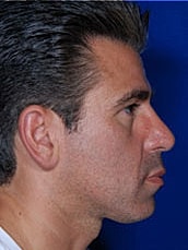 Rhinoplasty Before & After
