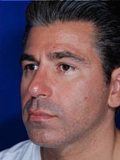 Rhinoplasty Before & After