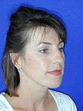 Rhinoplasty Before & After