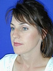 Rhinoplasty Before & After