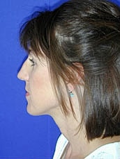 Rhinoplasty Before & After