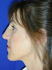 Rhinoplasty Before & After
