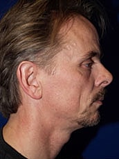 Rhinoplasty Before & After
