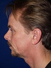 Rhinoplasty Before & After