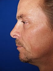 Rhinoplasty Before & After