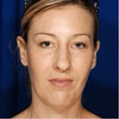 Rhinoplasty Before & After