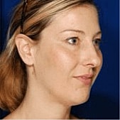 Rhinoplasty Before & After