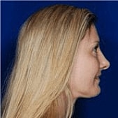 Rhinoplasty Before & After