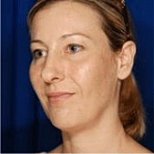 Rhinoplasty Before & After