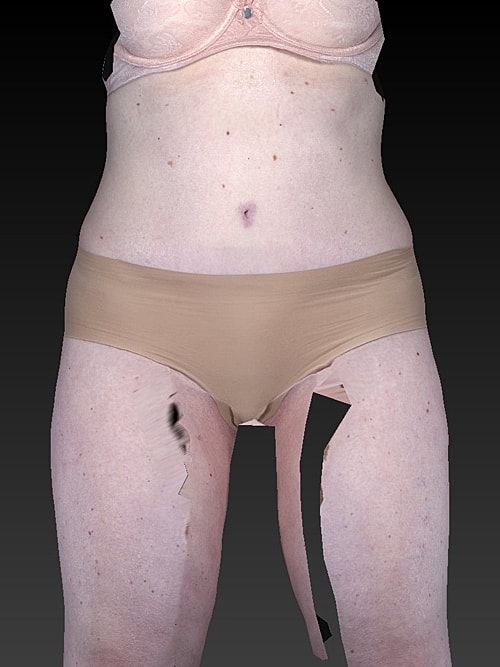 Tummy Tuck Before & After