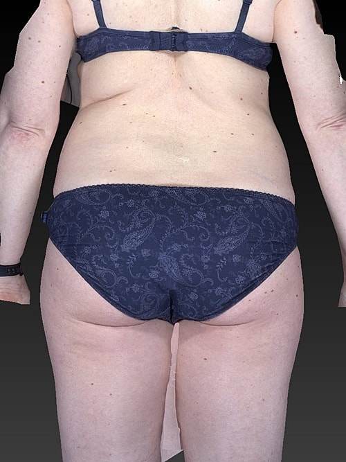 Tummy Tuck Before & After