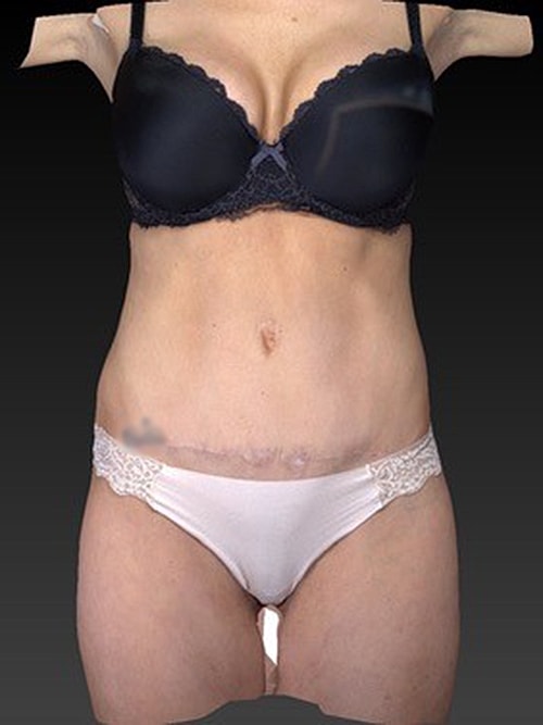 Tummy Tuck Before & After